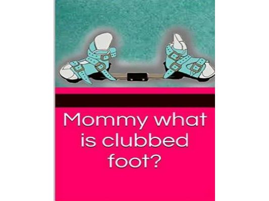 Mommy what is clubbed foot?