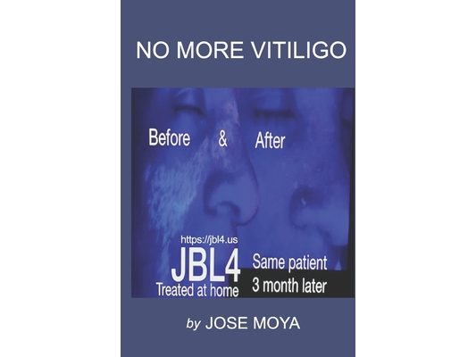 No More Vitiligo