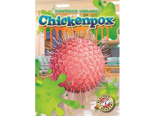 Chickenpox